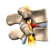 hernie discale vue latérale